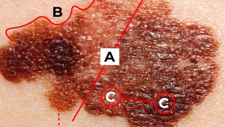 Patient from Florida Presents with Dermatologic Lesion: Diagnosis for Frequent Sun Tan Enthusiast