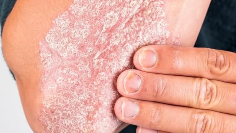 Patient Presents with Articular Pain and Silvery Dermatologic Lesions: Diagnostic Considerations