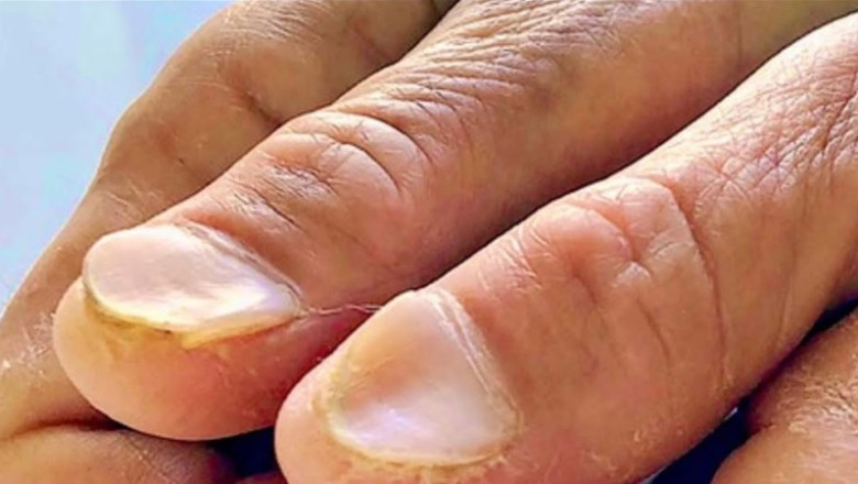 Patient Presents with Difficulty Swallowing, Anemia, and Fatigue: Diagnostic Considerations Based on Nail Examination