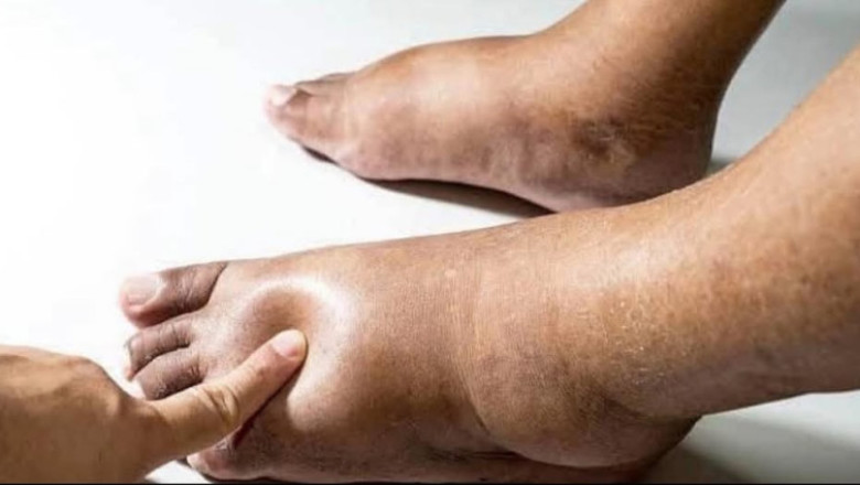 Patient Presents with Pitting Edema and Frothy Urine: Diagnostic Considerations