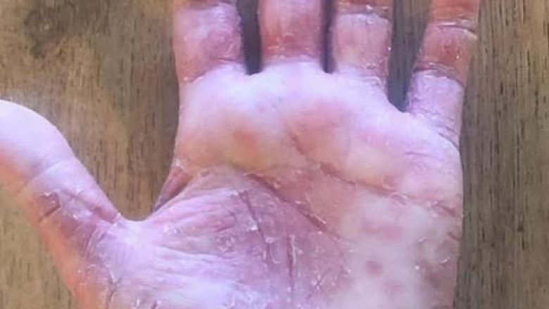 Patient Presents with Skin Lesion on Hand: Diagnostic Considerations and Potential Causes