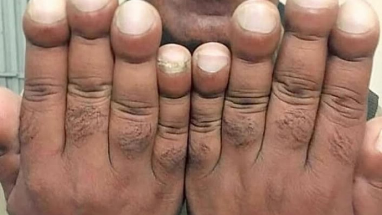 Patient with Prolonged Smoking History Exhibits Dyspnea, Exhaustion, and Nail Clubbing: Diagnostic Considerations
